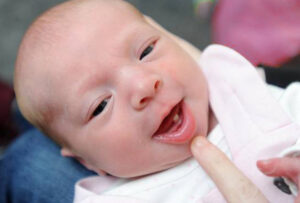 Read more about the article Infants Born with Teeth