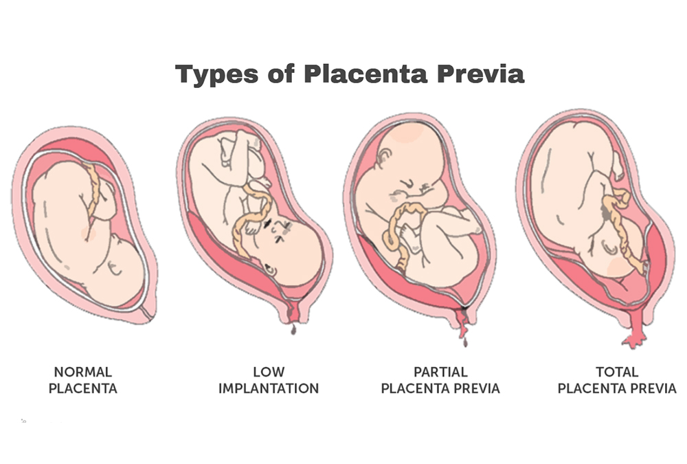Read more about the article Placenta Previa